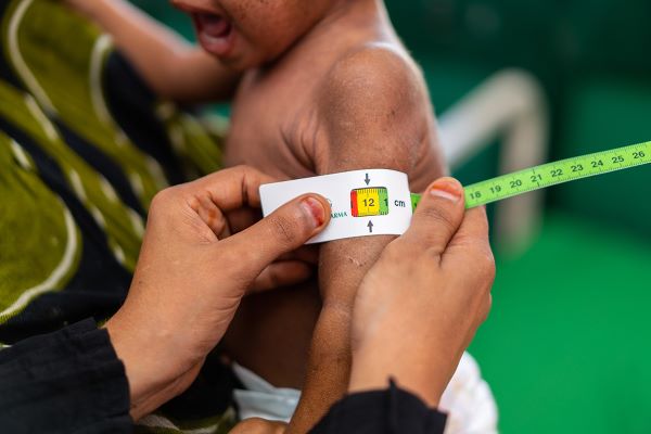 WHO-UAE Alliance Battles Child Malnutrition in Yemen’s Socotra